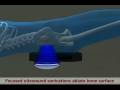 videos de Bone Mets (Bone Metastases) MRgFUS Treatment