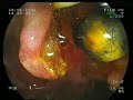 Koledok Ta?? ERCP ile Ta? Ç?kart?lmas? Koledok Ta?? ERCP ile Ta? Ç?kart?lmas?