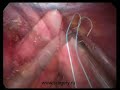 Esophageal hernia laparoscopic Nissen procedure. Part 2.