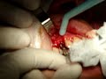 implantes tree oss_0001.wmv