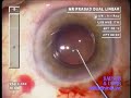 IOL VIP: A new treatment for dry macular degeneration