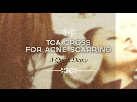 how to perform tca cross
