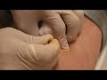 Baker's Cyst Drainage