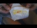 Wheelchair style - Nasty Burn 2nd Degree Burn & taking care of it (part 2) - L1 injury 4-1-12