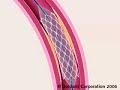 Angioplasty Angioplasty