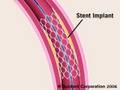 Angioplasty Risks Of Angioplasty | RM. Angioplasty Risks Of Angioplasty | RM.
