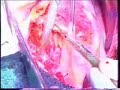 Cirug�a Cardiaca T�cnica de Ross