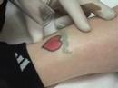 Laser Tattoo Removal Cherry Hill Laser &Skin Care Center NJ