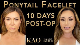 Amazing Facelift Results! Ponytail Facelift™ 10 Days After Plastic Surgery! - Lip Lift - Neck Lift