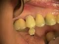 Immediate Implant and Provisional