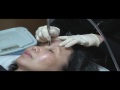 Microdermabrasion Demonstration by Dr Young of Seattle / Bellevue Washington