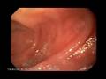 Endoscopia digestiva