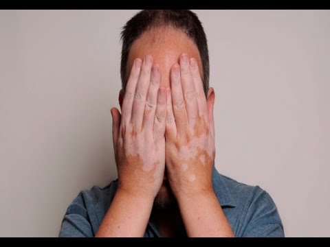 how to cure vitiligo naturally