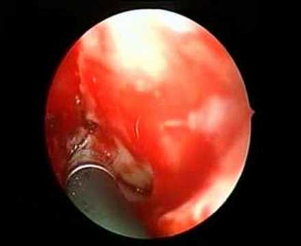 Sphenopalatine artery diathermy