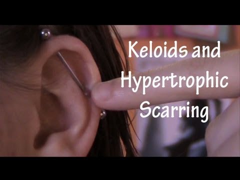 What really is the difference between keloids and scarring? Find out now! Hope this helps people! If you have a question, feel free to send me a private 