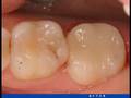 Before & After Cosmetic Photos- Crowns, Onlays and Veneers