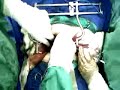 la rioja argentina, calculo vesical por dr gonzalez