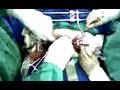 la rioja argentina, calculo vesical por dr gonzalez