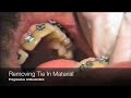 Removing Tie-In Materials