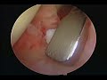 Frozen shoulder capsular release
