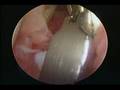 Capsule Incision In Case Of Frozen Shoulder