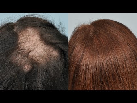 how to relieve zingers