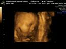 3D sonar