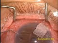 Trabeculectomy Mitomycin C Left Eye