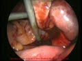 pembedahan laparoscopy - cyst with non communicating horn