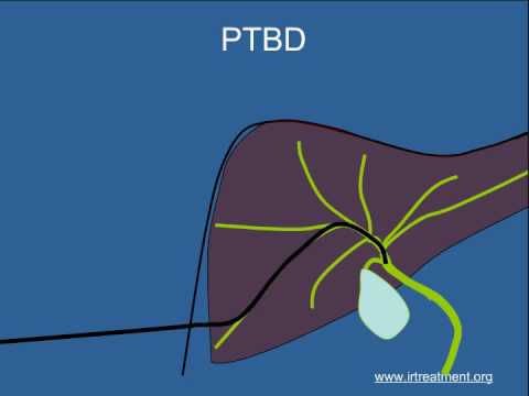 how to drain biliary drain