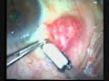 Trabeculectomy with MMC