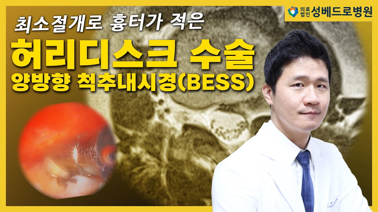 [나의주치의]최소절개로 흉터가 적은 허리디스크 수술 양방향 척추내시경(BESS)