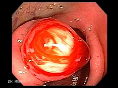 how to treat ileocecal valve syndrome