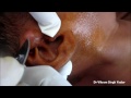 Drainage Of Abscess (Ear Pinna)