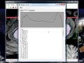Corpus Callosum Program tutorial