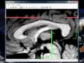 Corpus Callosum Program tutorial
