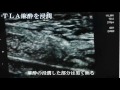下肢静脈瘤2000nmレーザー手術動画【北青山Dクリニック】 静脈瘤