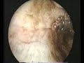 hysteroscopic treatment of intra uterine myoma