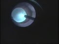 intravitreal cysticercosis intravitreal cysticercosis