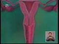 Vacina Cancro Colo do Utero