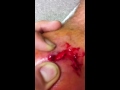 Lancing mrsa part 2