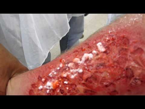 how to treat hf acid burns