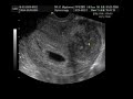 Ultrasound: 6 Weeks and 4 days old fetus