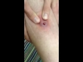 Pussy cyst