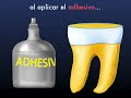 Aplicación de adhesivo dentinal y su fuerza de adhesion Aplicación de adhesivo dentinal y su fuerza de adhesion