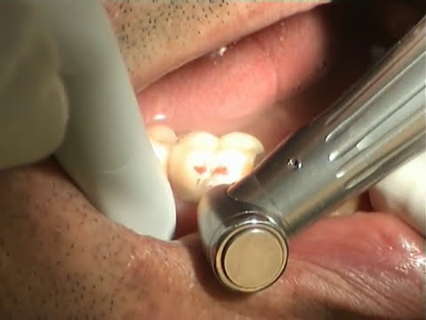 how to repair pfm crown