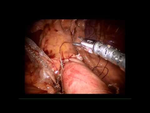 how to treat bile reflux