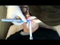 Gingival Tissue Removal with a Laser