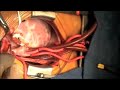 Williams Syndrome, Repair of Supravalvar Aortic Stenosis