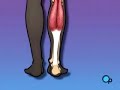 PreOp® Patient Education Orthopedic: Achilles Tendon Repair